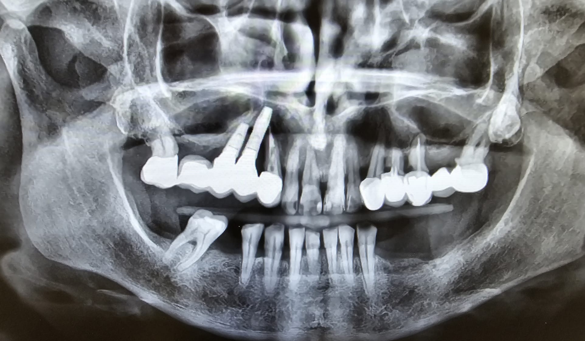 Radiografia pre intervento