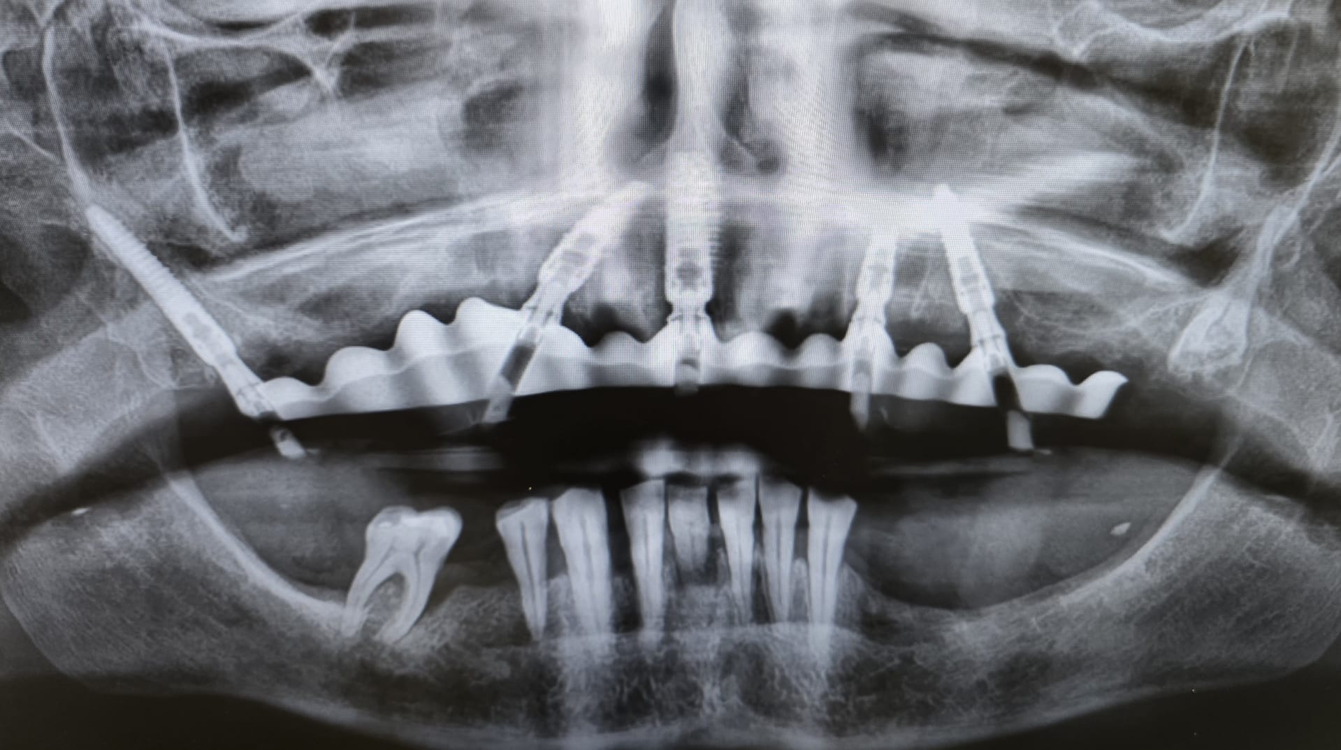 Radiografia post intervento
