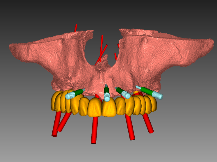 Pianificazione implantare 2